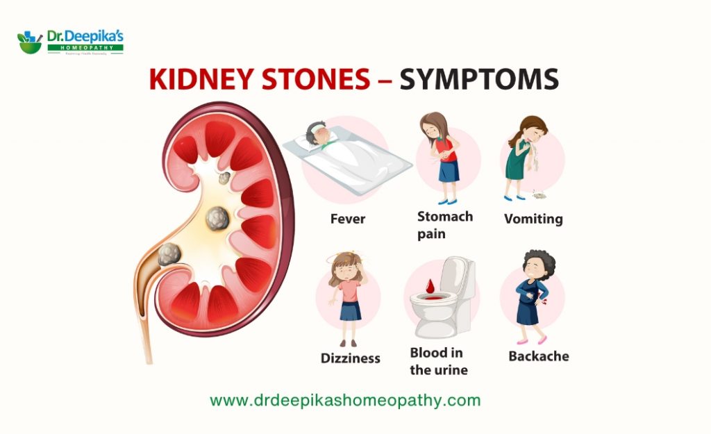 symptoms of kidney stones