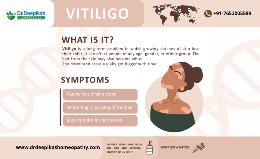 symptoms of vitiligo