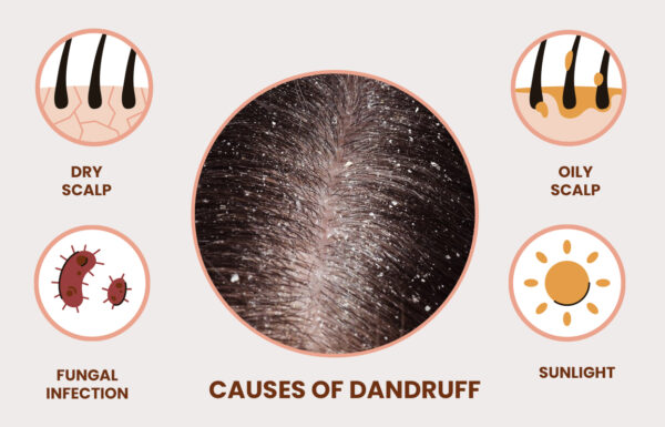 Causes of Dandruff