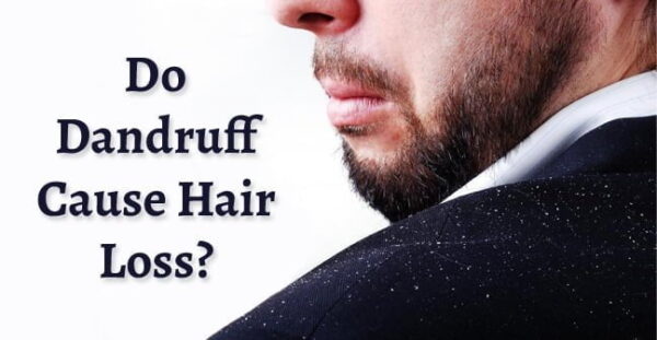 Do Dandruff Cause Hair Loss - Is Dandruff Causing Your Hair Loss? Homeopathy Treatment