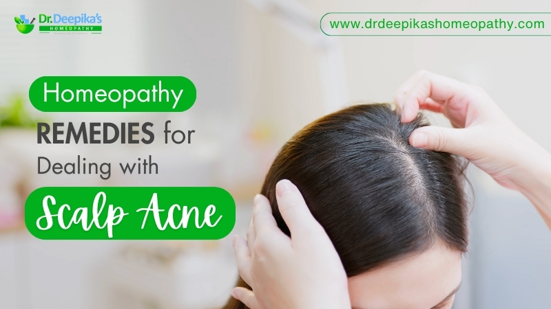 Dealing with Scalp Acne: Causes, Treatment, and Homeopathy Remedies