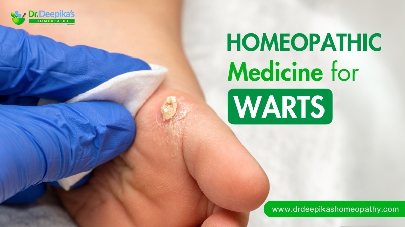 Homeopathic Treatment for Warts with Dr. Deepika