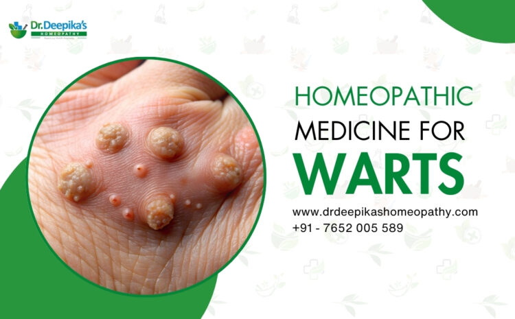 Homeopathic Medicine for Warts