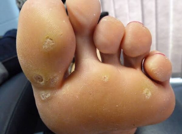 What Are Warts