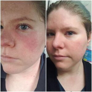 homeopathy treatment for acne