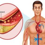 homeopathic medicine for cholesterol