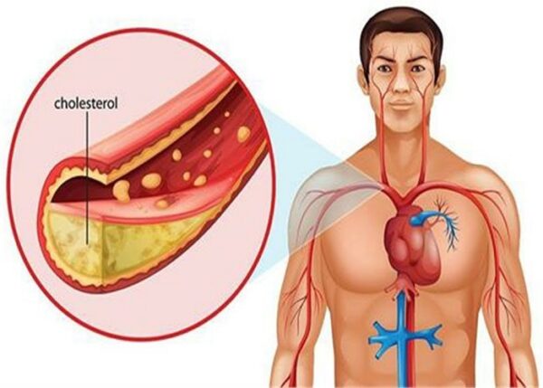 homeopathic medicine for cholesterol