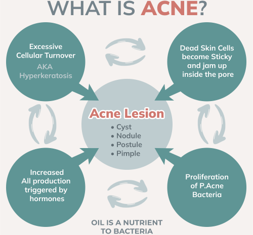 What is Acne?