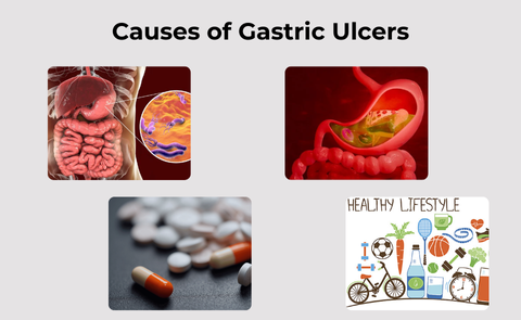 causes of gastric ulcer