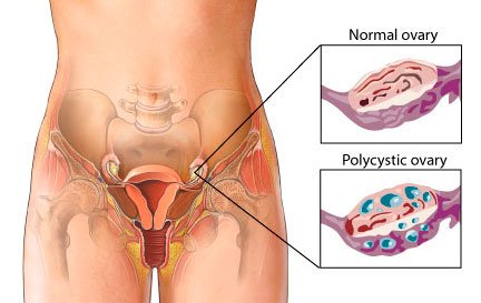 what is the difference between pcod and pcos