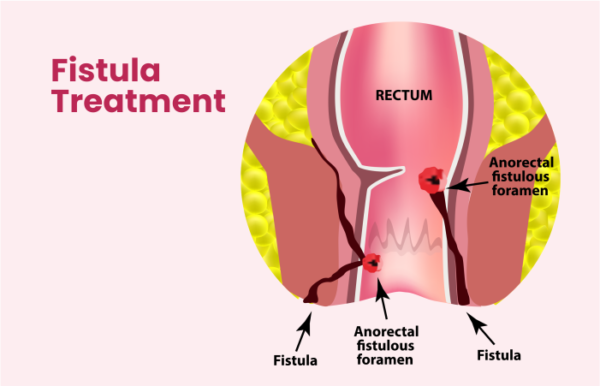 fistula treatment in homeopathy