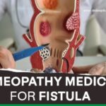 Homeopathy Medicine for fistula 4 - Homeopathy Medicine for Fistula