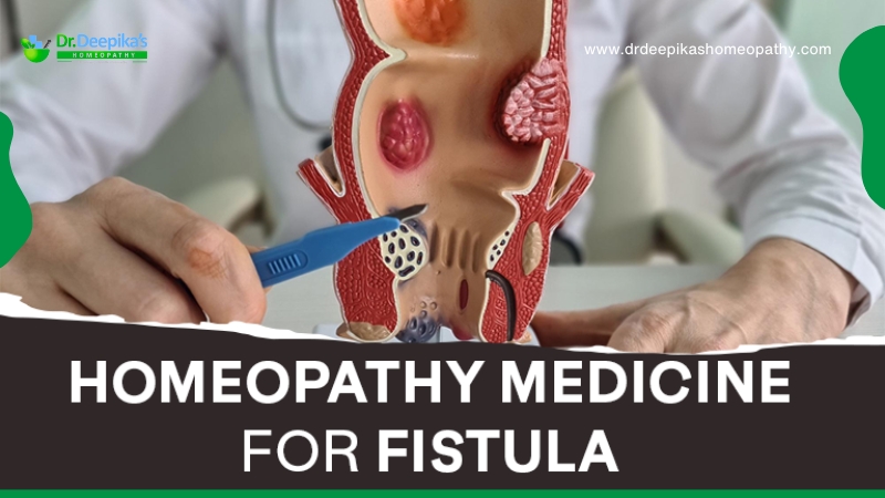 Homeopathy Medicine for Fistula