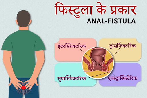 Types of Fistula