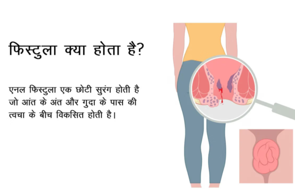 What is Fistula