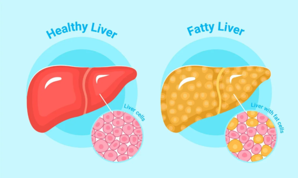 What is Fatty Liver