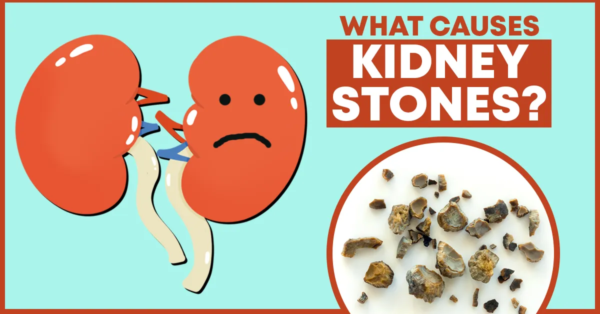 Causes of Kidney Stones