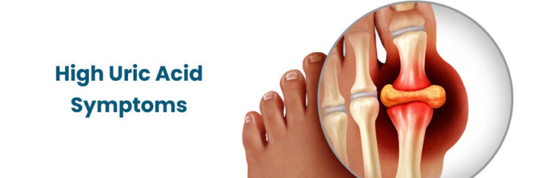Symptoms of Uric Acid