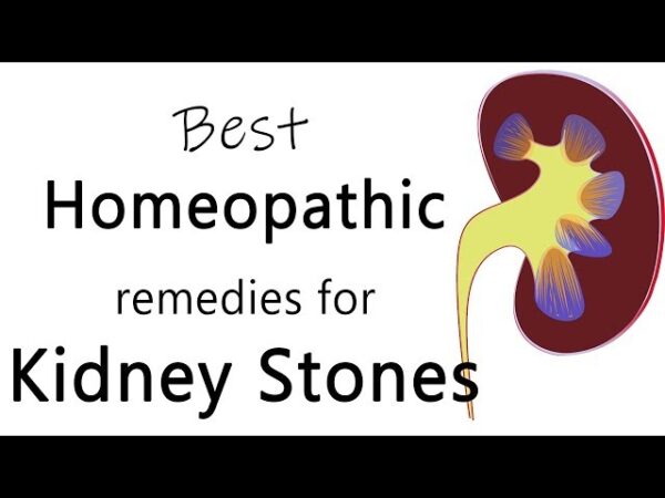 homeopathic kidney stone treatment