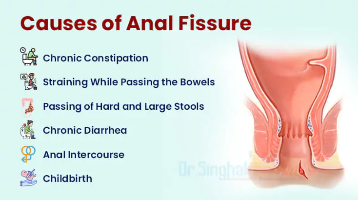 Causes of Fissure