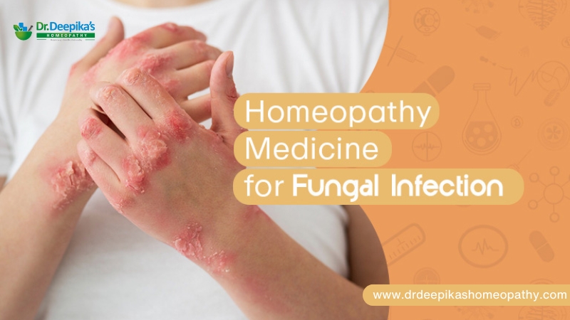 Homeopathy Medicine for Fungal Infection | Dr. Deepika