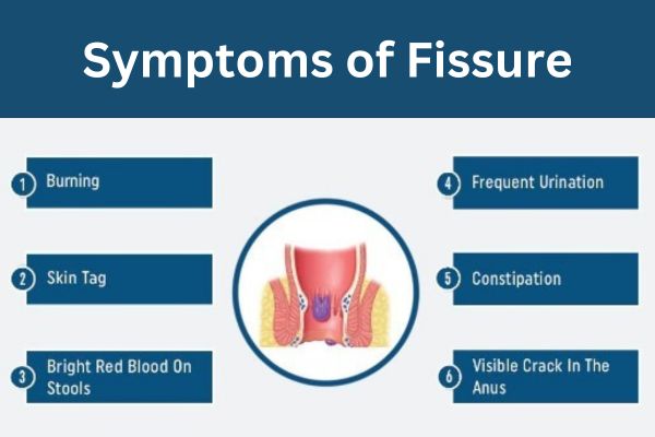 Symptoms of Fissure