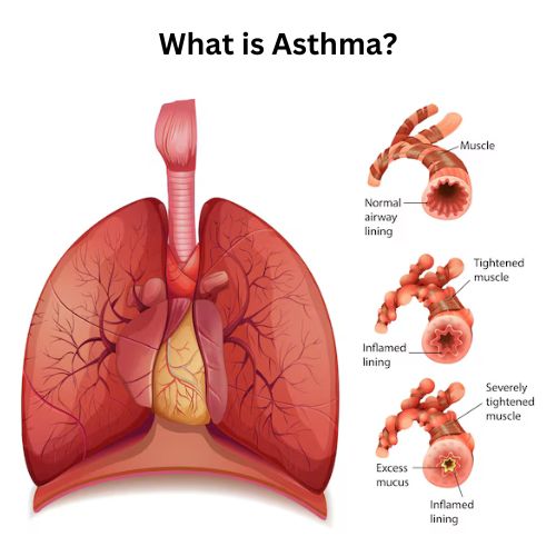 What is Asthma?