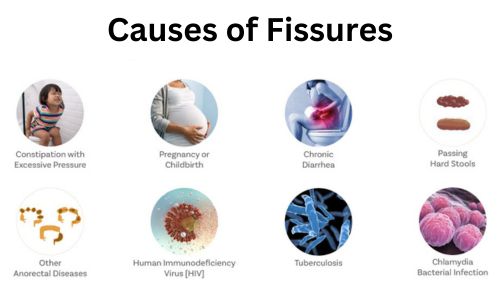 Causes of Fissures