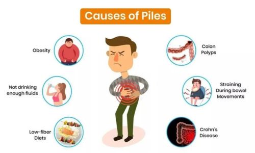 Causes of Piles