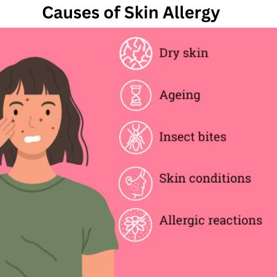 Causes of Skin Allergy