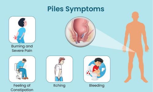 Symptoms of Piles