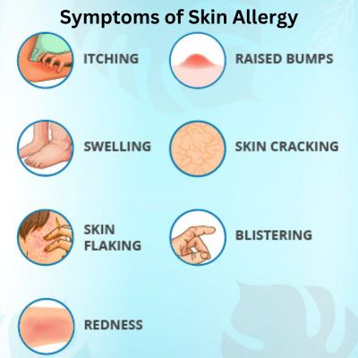 Symptoms of Skin Allergy