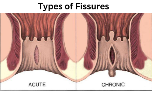 Types of Fissures