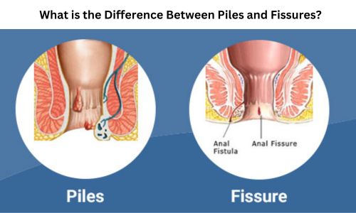 What is the Difference Between Piles and Fissures?