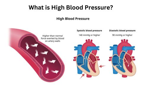 What is High Blood Pressure?