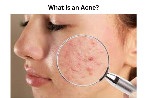 What is an Acne What is acne?