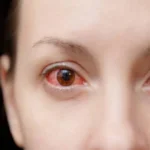 Homeopathic Medicine for Conjunctivitis