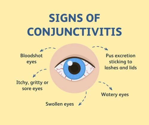 Symptoms of Conjunctivitis - Homeopathic Medicine for Conjunctivitis (Pink Eye)