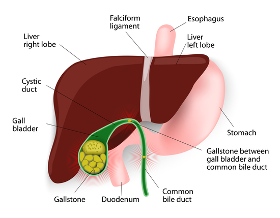 What is Gallbladder Stones?