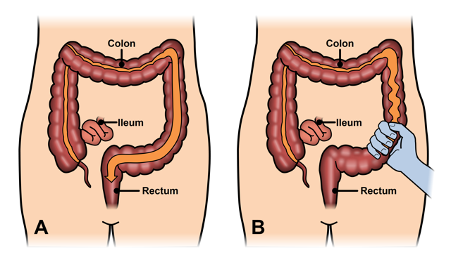 What is IBS