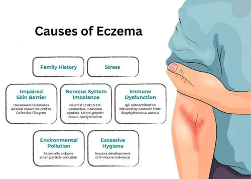 Causes of Eczema - Homeopathy Medicine for Eczema