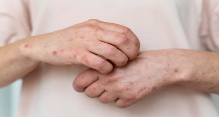 Homeopathy Skin Disease Treatment