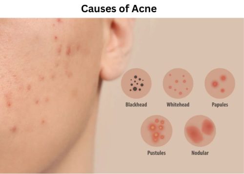 Causes of Acne Causes of Acne