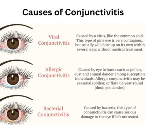 Causes of Conjunctivitis Causes of Conjunctivitis