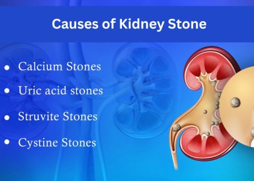 Causes of Kidney Stone Causes of Kidney Stone