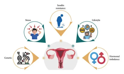 Causes of PCOS Causes of PCOS