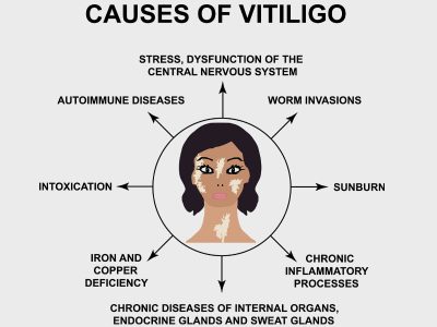 Common Causes of Vitiligo Causes of Vitiligo