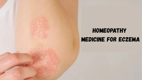 Homeopathy Medicine for Eczema