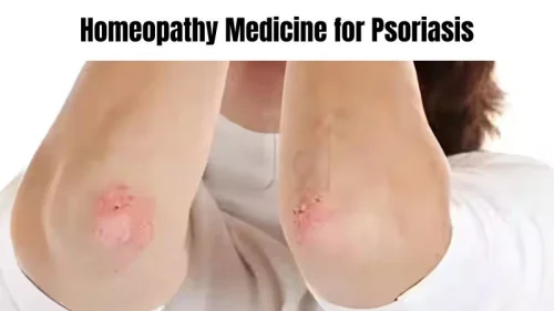 Homeopathy Medicine for Psoriasis