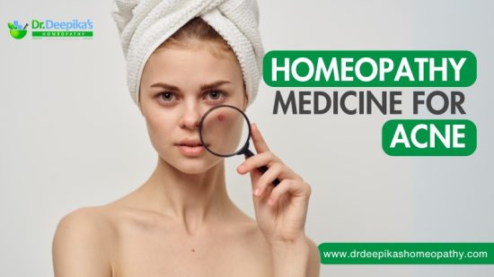 Homeopathic Treatment for Acne
